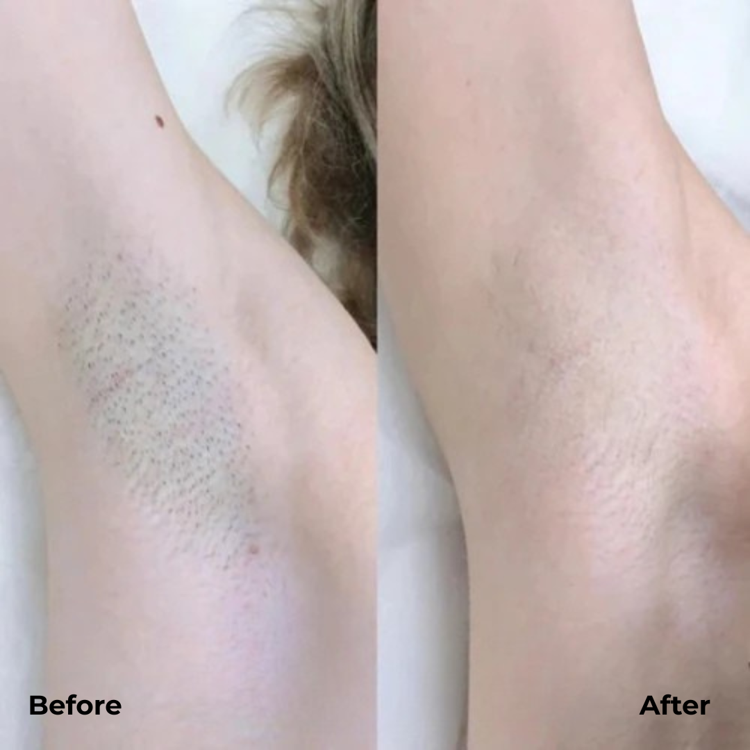 SilkTrim Pro™ - Get Salon-Smooth Legs in 60 Seconds (+ FREE Mystery bonus)