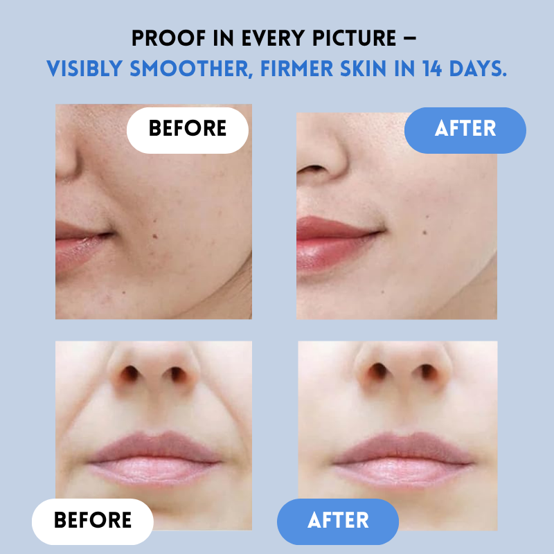 YouthLift™ Renew Strips – The Instant Solution for Timeless Beauty (1+1 FREE)