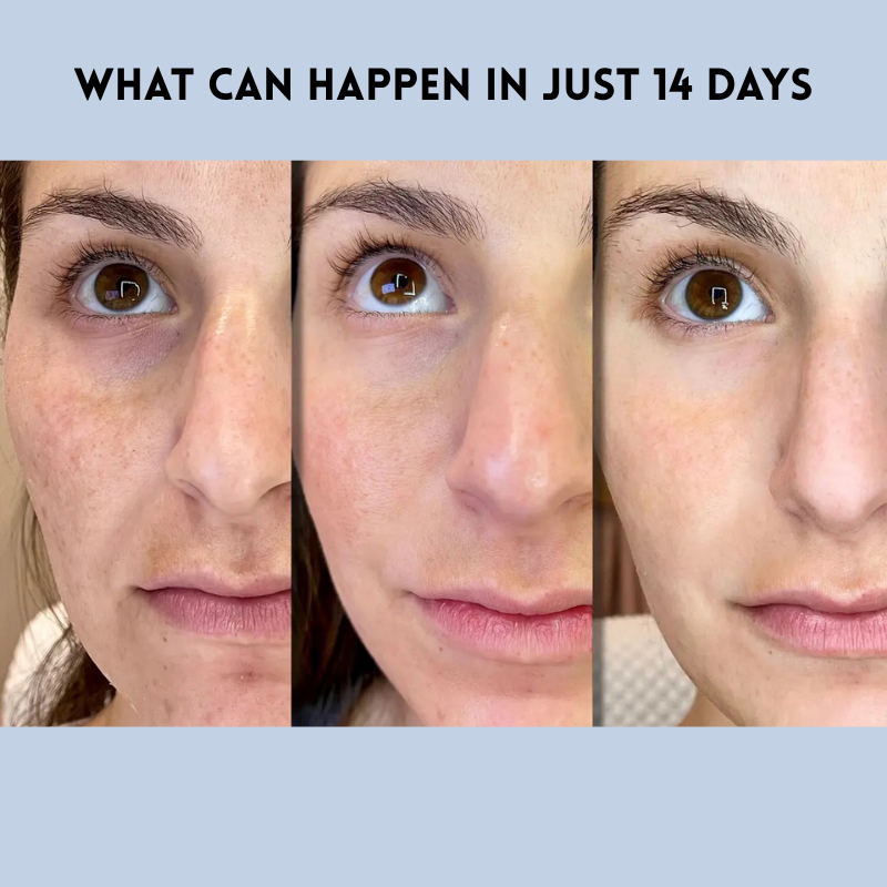 YouthLift™ Renew Strips – The Instant Solution for Timeless Beauty (1+1 FREE)