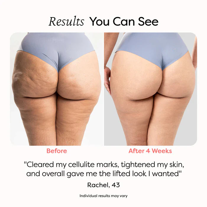 SmoothRoll Elite™ - Erase Cellulite, Reveal Smooth Skin (+ FREE Mystery bonus)