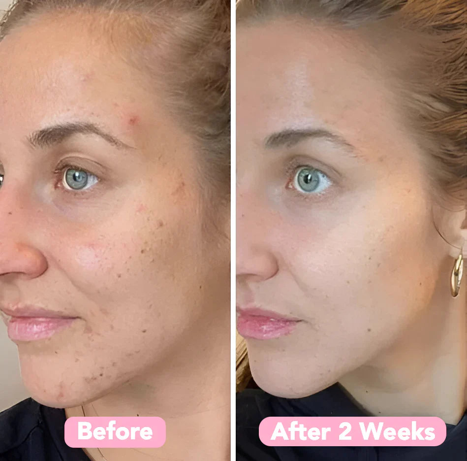 GlowReveal™ - Erase Dark Spots In 14 Days Or Less (40 Pads)